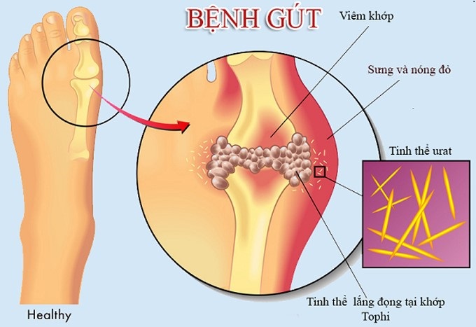 TRÀ AN GÚT HƯNG –GIẢM CƠN ĐAU DO BỆNH GÚT GÂY RA, ĐÀO THẢI ACID URIC HIỆU QUẢ